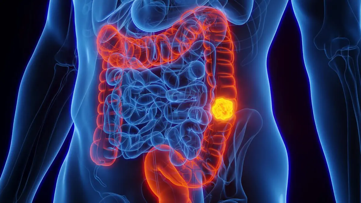Colorectal Cancer: Awareness, Prevention, and Treatment
