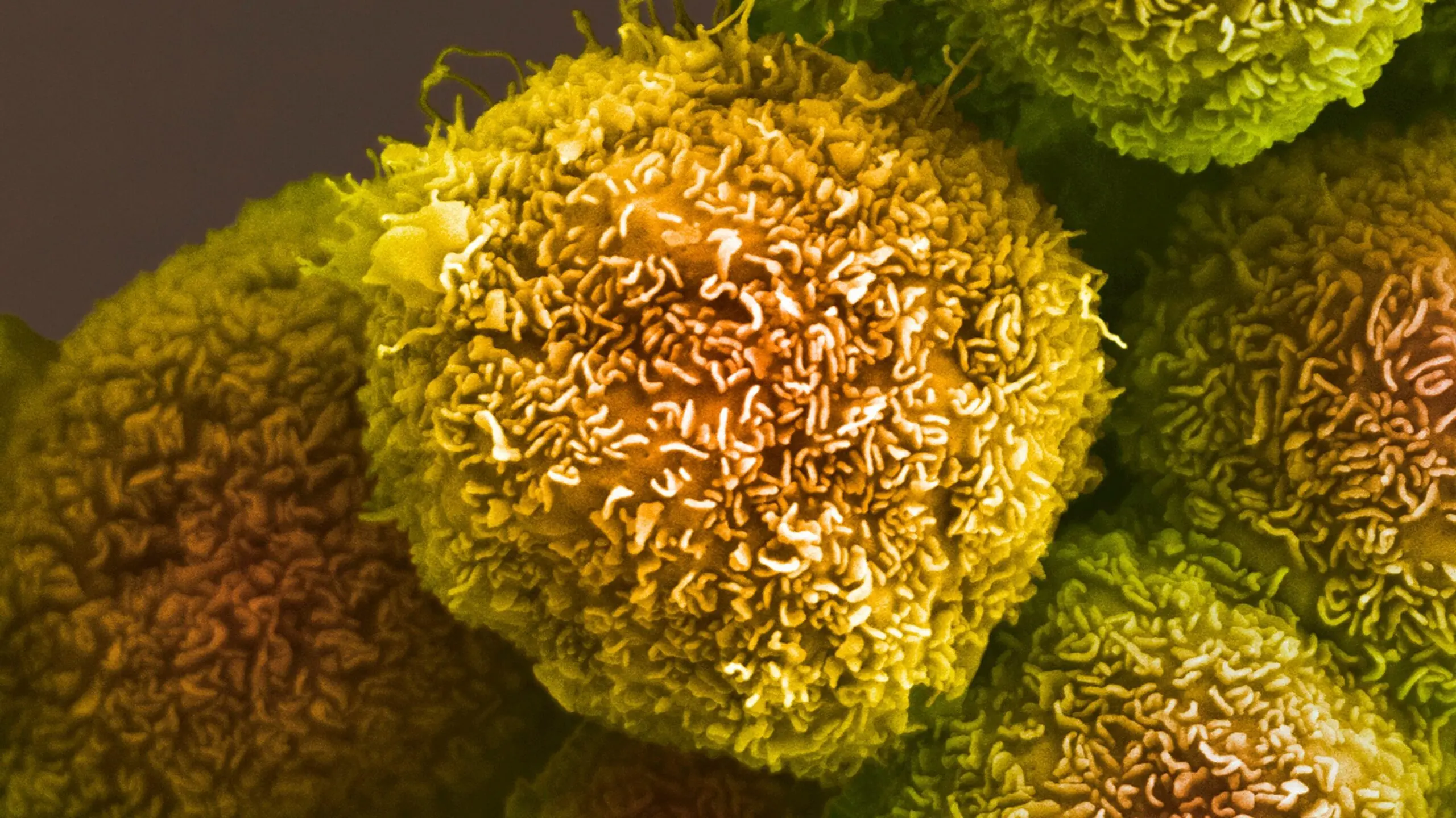 Recent Advances Toward a Pancreatic Cancer Cure
